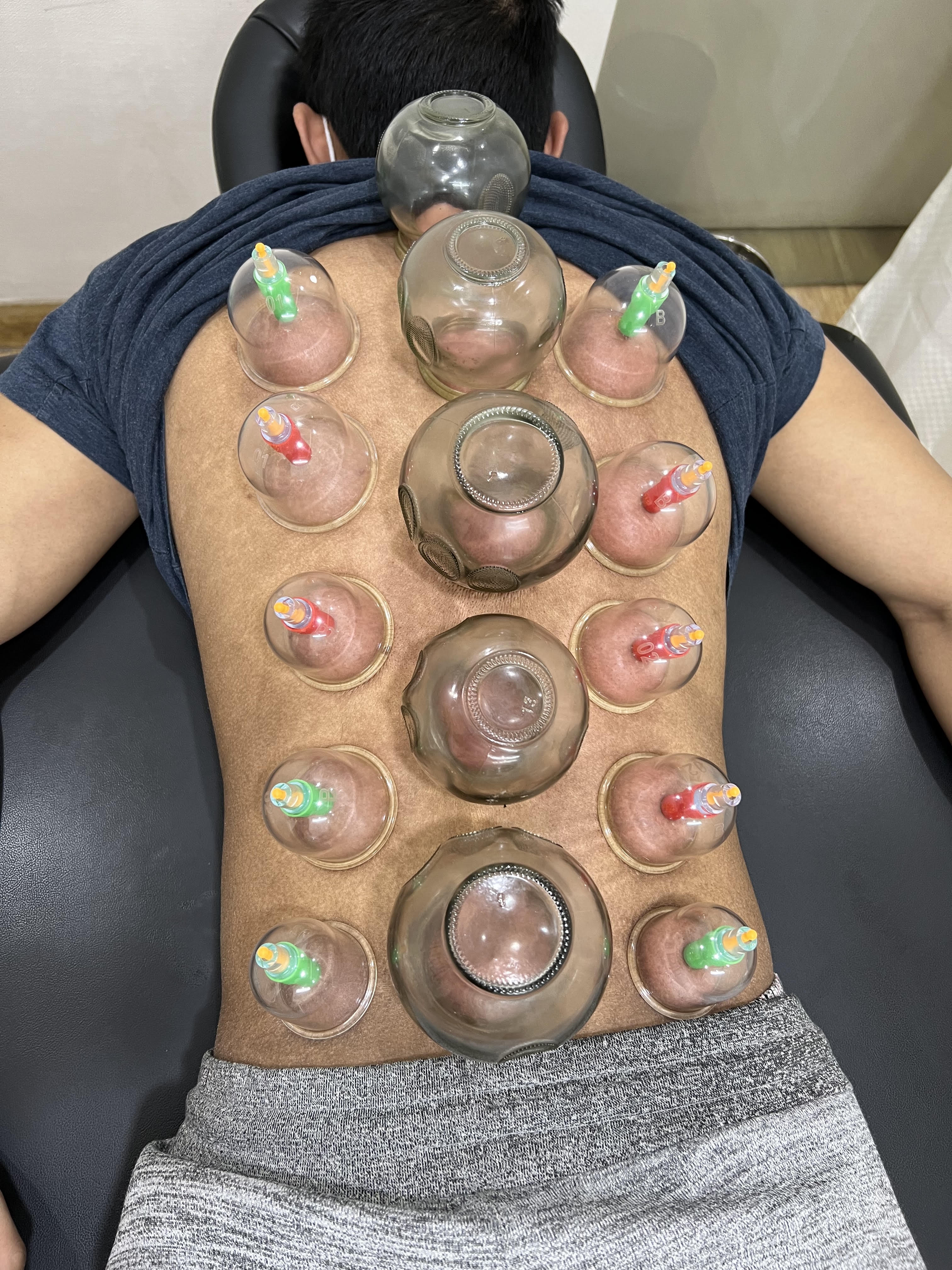 Step 04: Spinal Decompression & Medical Cupping Therapy